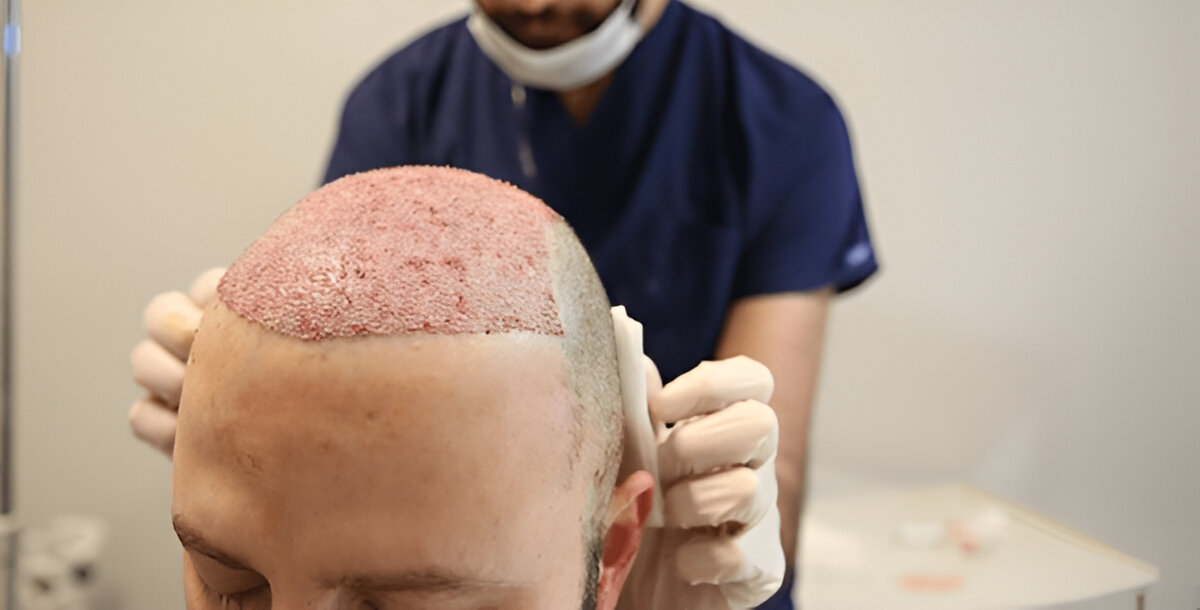 hair transplant London