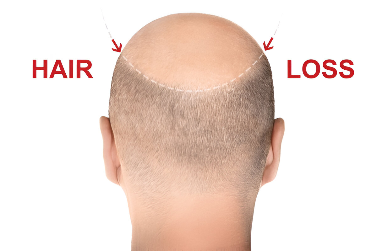 hair transplant