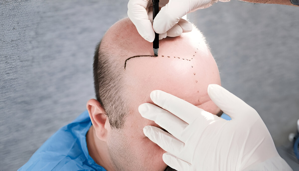 Hair Transplants