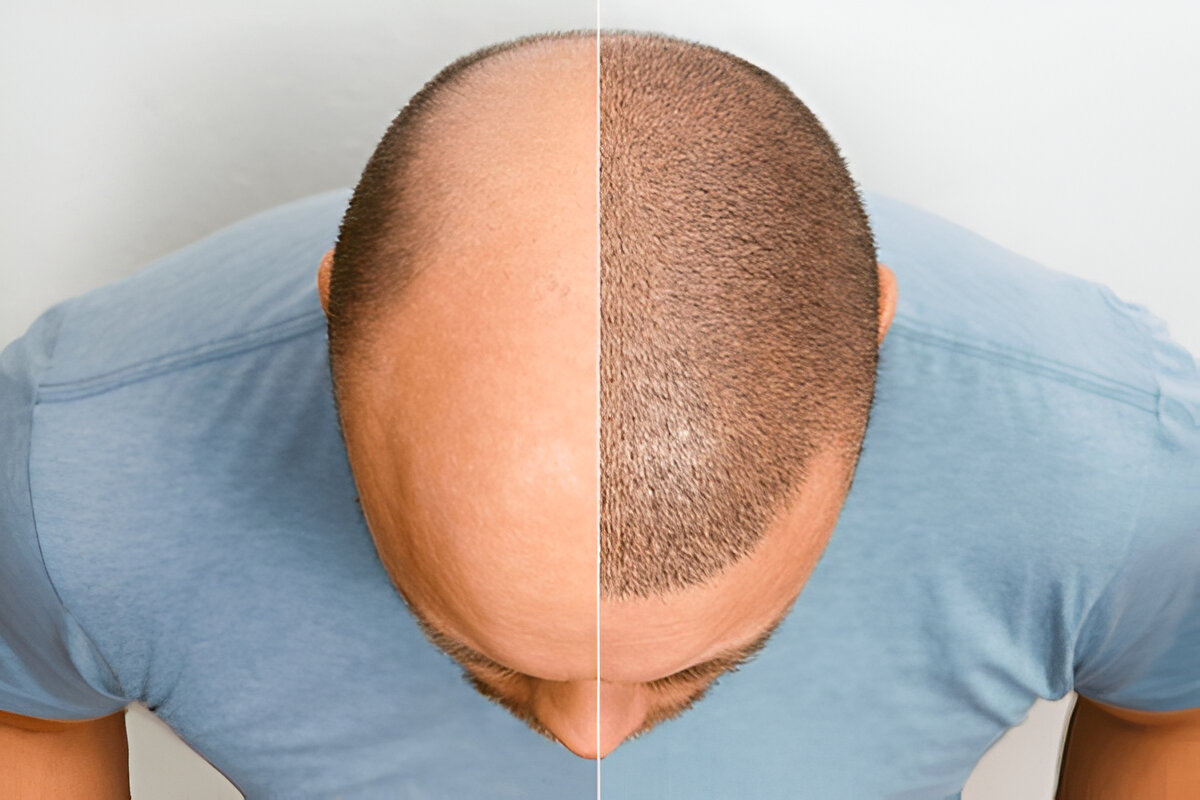 Is FUE or FUT the Best hair Transplant London Option for You