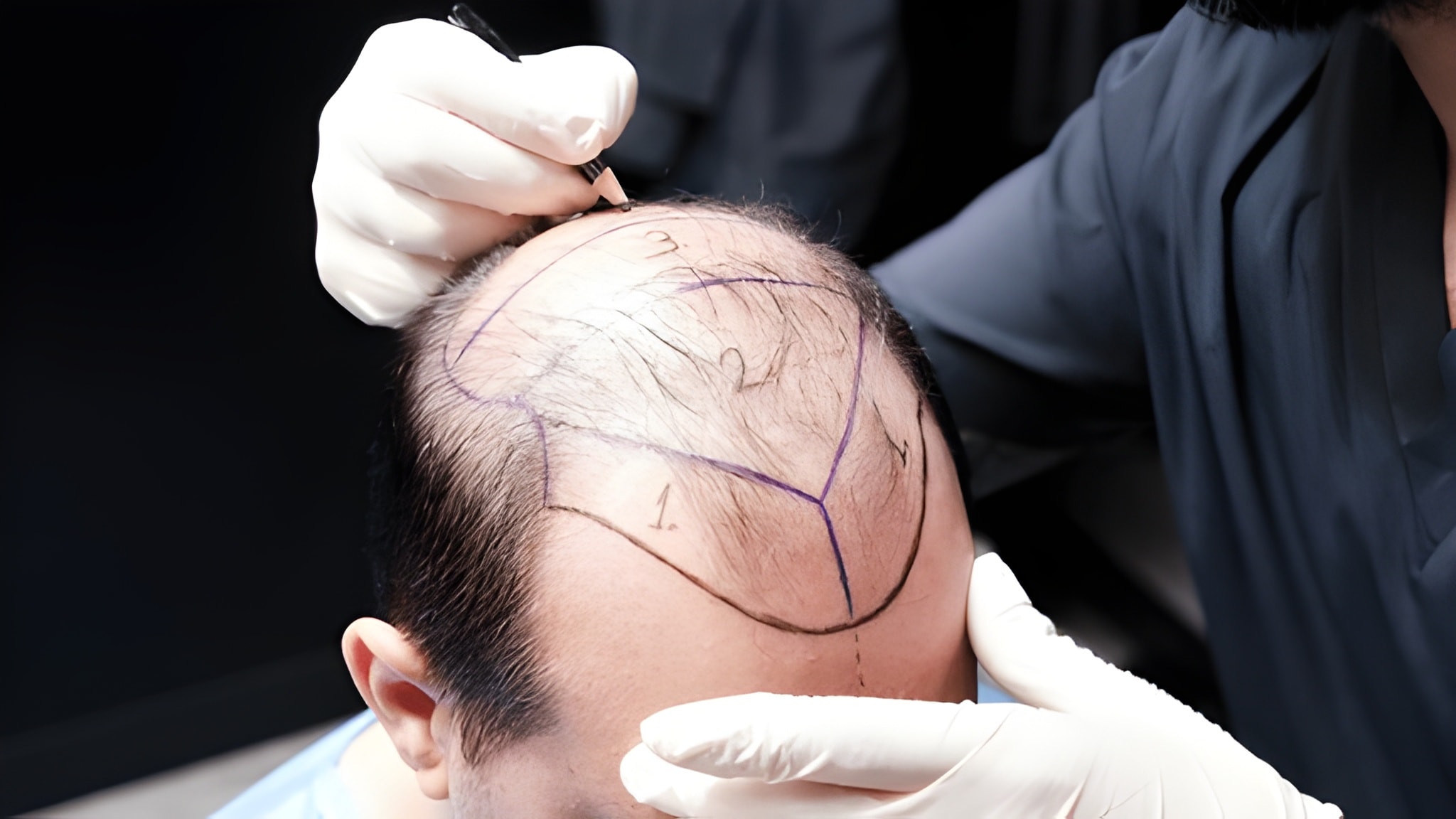Hair Transplant