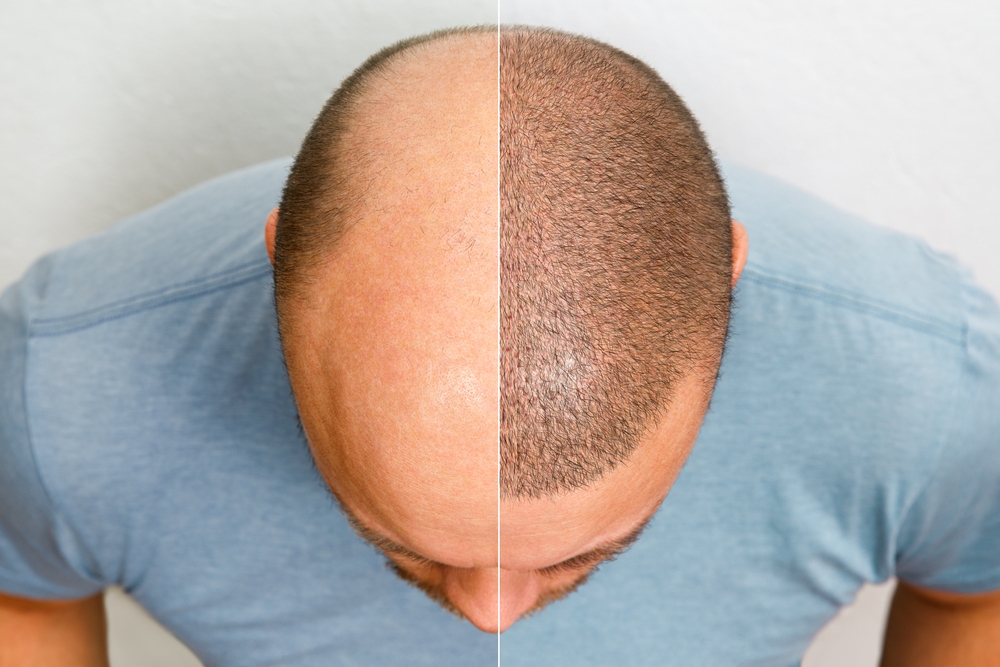 hair transplant London